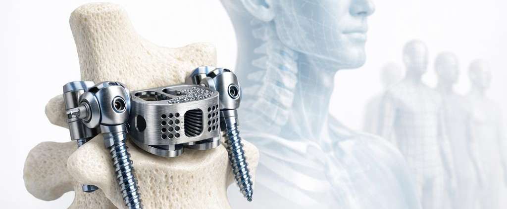 In silico Trials: Can we test implants on virtual populations?