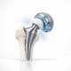Predicting Prosthetic Loosening through Acoustic Sensors.